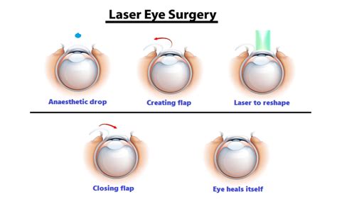 Advanced Options for Refractive Surgery (LASIK)