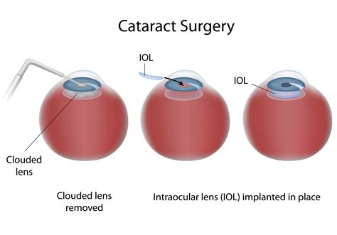 Advanced Surgical Options (Cataracts, LASIK)