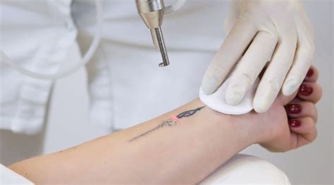 Laser Tattoo Removal Before and After 1 treatment