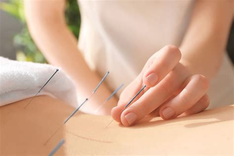 Akupunktur