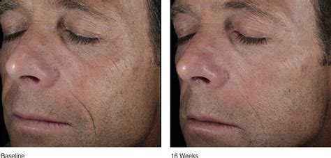 Revive Your Skin's Youthful Glow with Alastin Restorative Skin Complex: Astonishing Before and After Results!