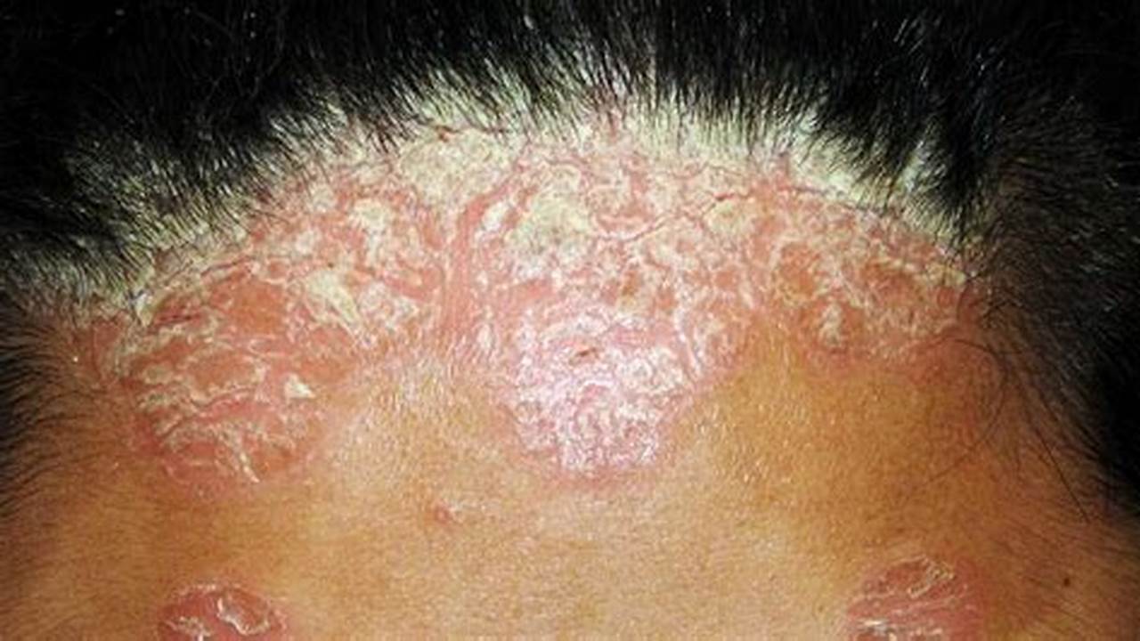 Alergi, Penyakit Rambut