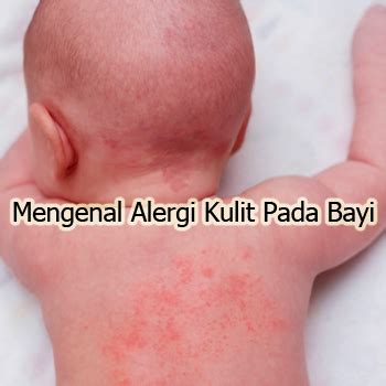 Alergi Bayi 2