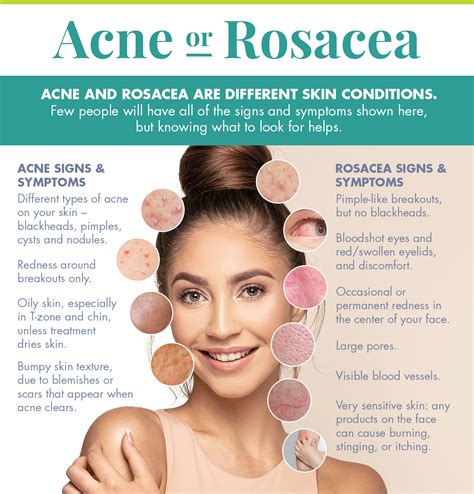 Acne rosacea Stock Image C050/0875 Science Photo Library