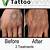 All Natural Tattoo Removal