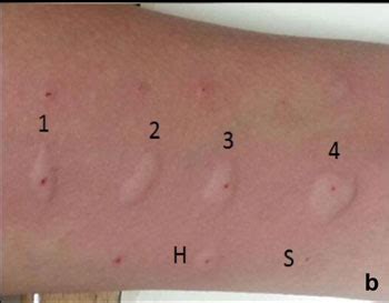 Liven up your SEO with this snappy title: Unveiling the Intricacies of Allergy Skin Test Wheal Size - Insights, Measures and Interpretation