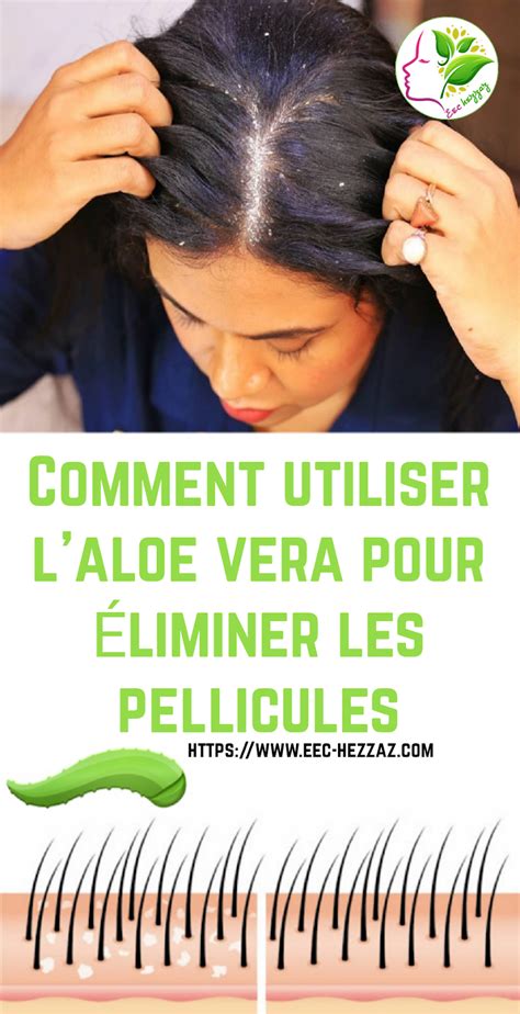 Aloe Vera pellicules