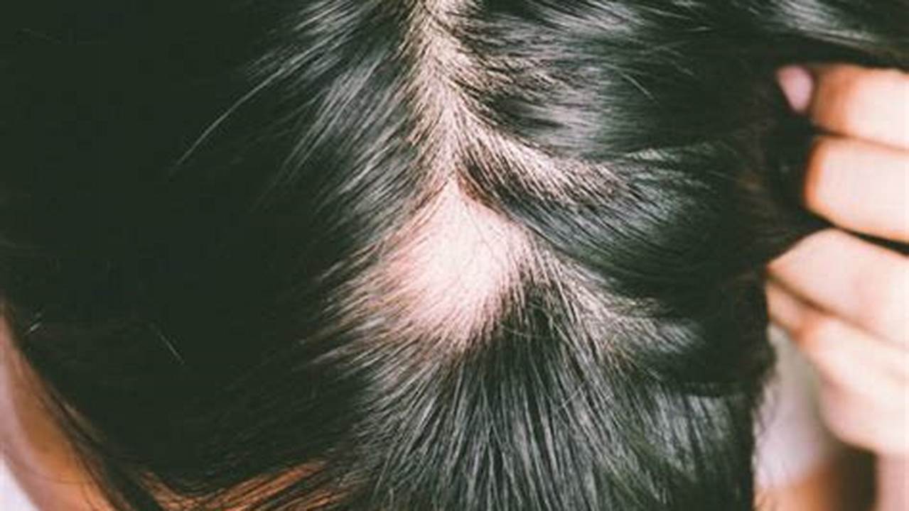 Alopecia Areata, Penyakit Rambut