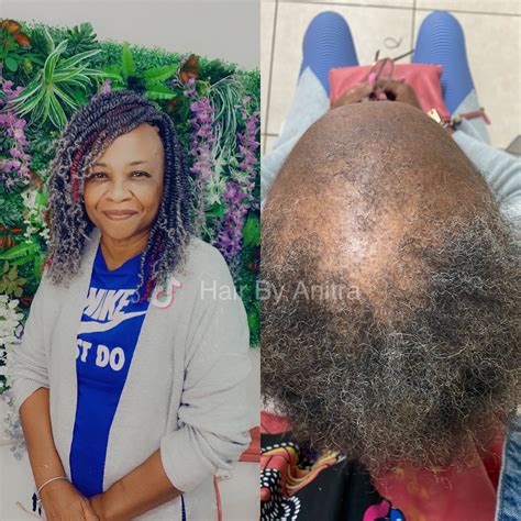 Alopecia Crochet Braids