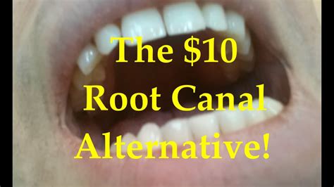 Alternative To Root Canal