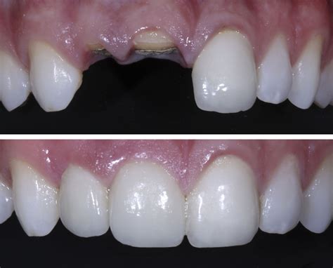 Alternatives to a root canal before receiving a crown