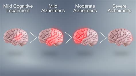 Alzheimer’s Victims Brain