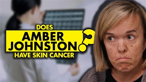 Unmasking the Silent Killer: The Courageous Battle of Amber Johnston Against Skin Cancer