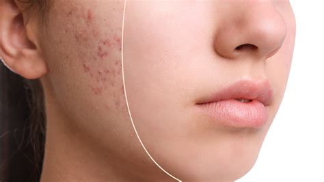 Acne reasons skin problems and diseases beauty Vector Image