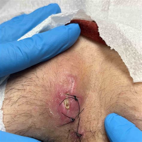 Eliminate Embarrassment: Discover the Incredible Benefits of Anal Skin Tag Band- The Ultimate Solution for Flawless Skin!