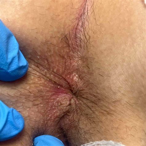 Quick Guide: Anal Skin Tag Removal Recovery Tips