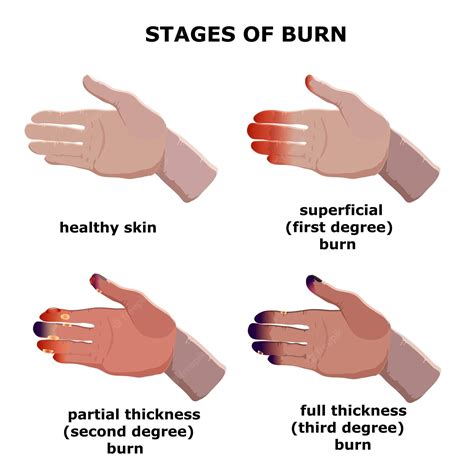 Analysis: to burn or not to burn