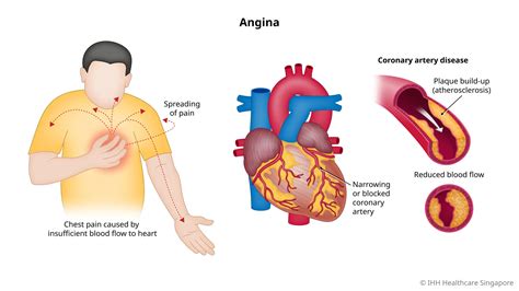 Angina Pektoris
