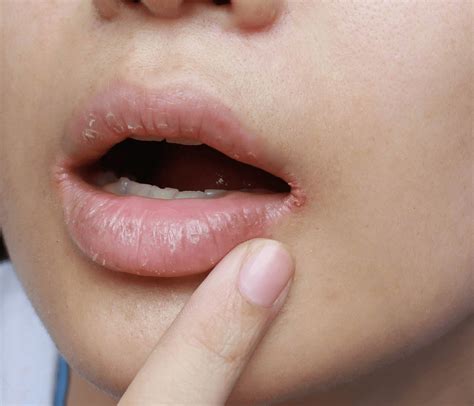 12 Natural Treatments for Angular Cheilitis