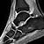 Ankle Ligaments Mri