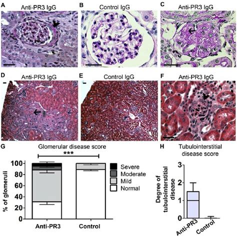 Anti-PR3 Test and interpretation