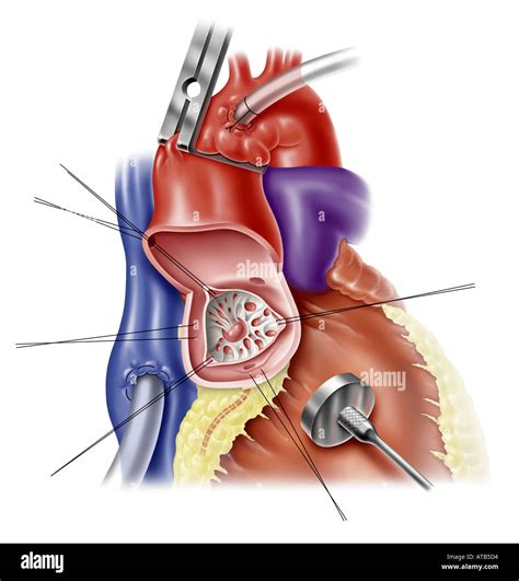 Aortic Valve Replacement: Options & Recovery