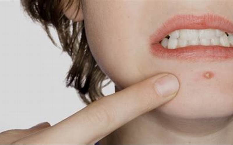 Apa Penyebab Jerawat Di Bibir?