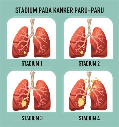 Apa itu Kanker Paru Stadium 4?