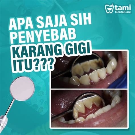 Apa yang menjadi penyebab karang gigi?