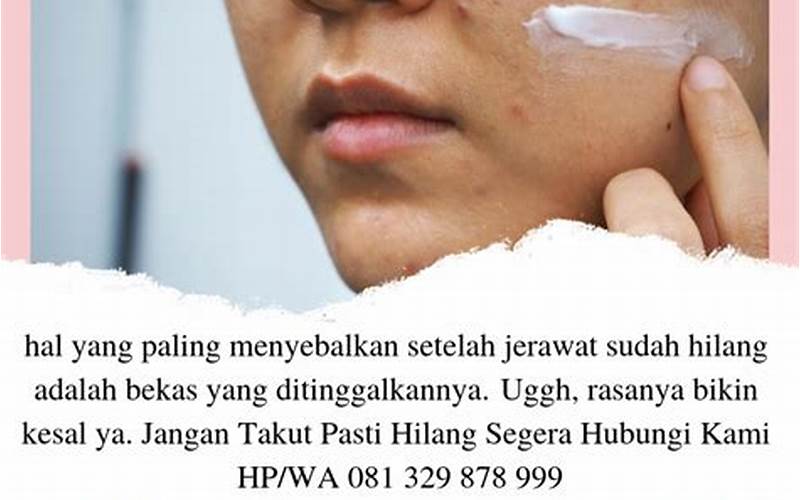 Apakah Benar Odol Bisa Menghilangkan Jerawat?