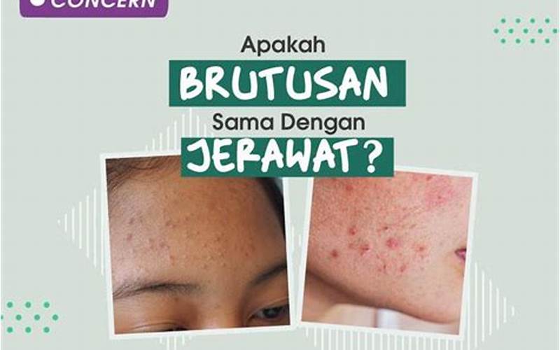 Apakah Bruntusan Sama Dengan Jerawat?