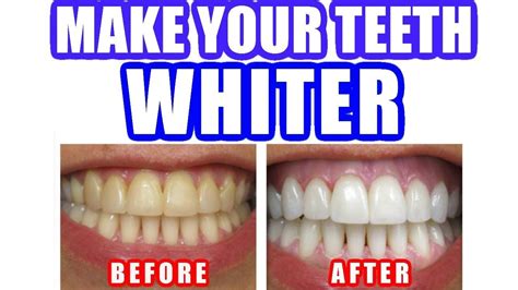 Say Cheese! Achieve a Brighter Smile with our Top-Rated Teeth Whitening App!