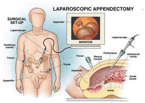 Appendectomy: When to Remove Your Appendix Now.