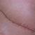 Appendix Removal Scar