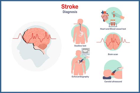 Application in Stroke Diagnosis