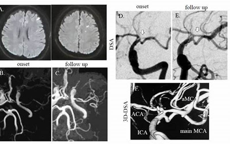 Applications Of Digital Subtraction Angiography In Medicine