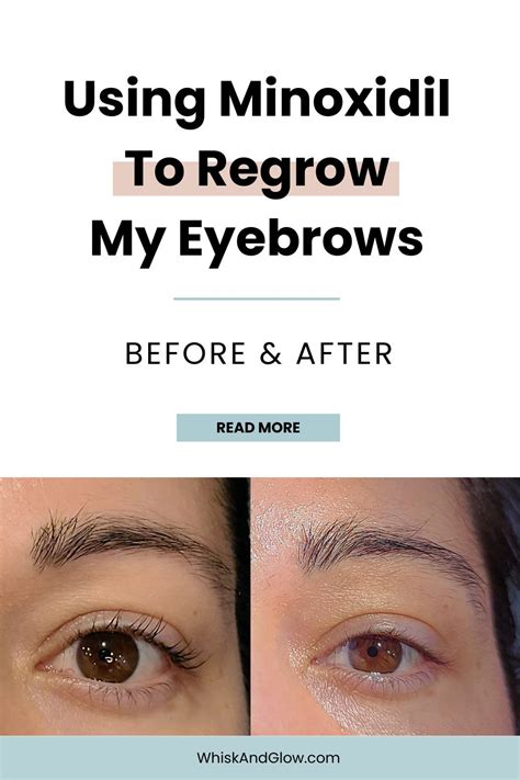 Applying Minoxidil to Eyebrows
