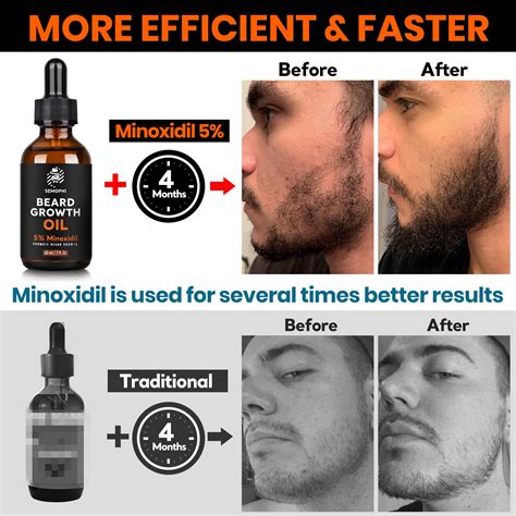 Applying Minoxidil to Beard