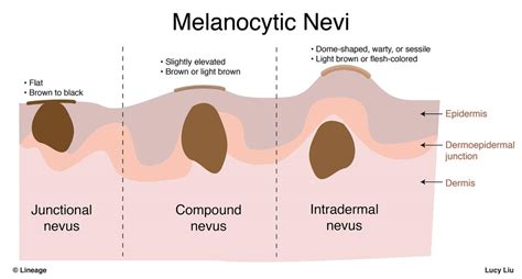 Are There Any Complications with Junctional Melanocytic Nevus with Mild Atypia?