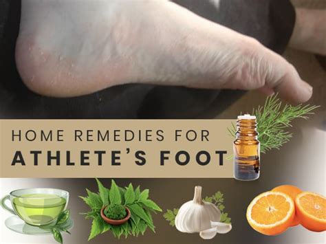 Are There Any Home Remedies for Athlete's Foot in Dogs?