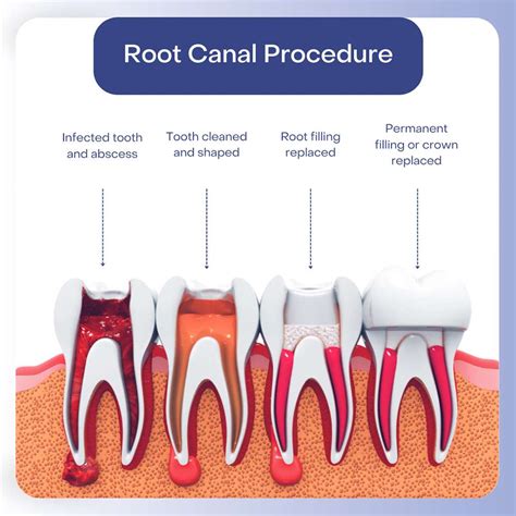 Are You Awake For A Root Canal