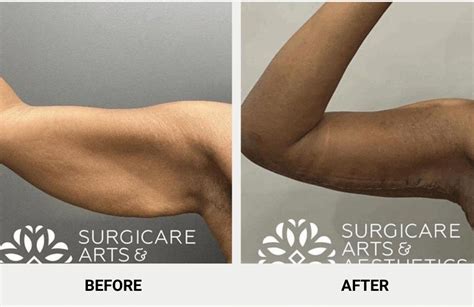Say Goodbye to Saggy Skin with Arm Surgery – The Ultimate Solution!
