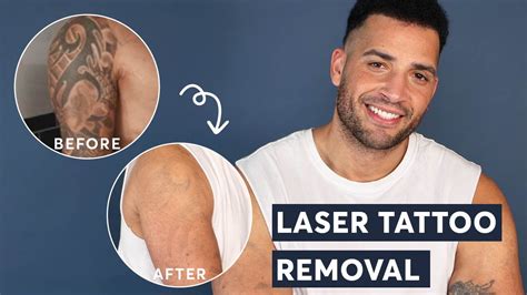 40+ Laser Tattoo Removal Results Half Sleeve, Great