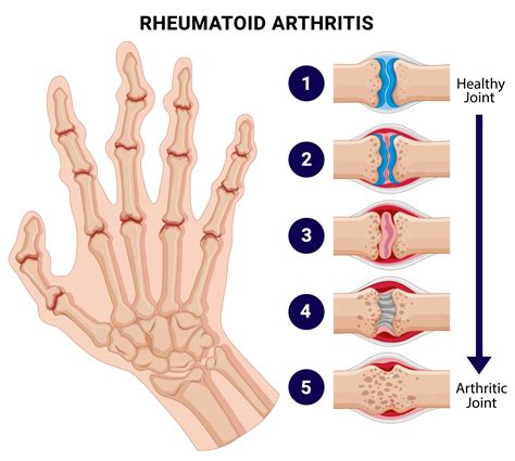 Arthritis Rheumatoid