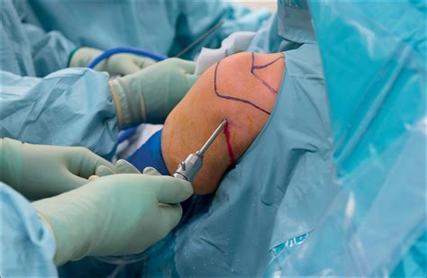 Arthroscopic Shoulder Surgery Costs