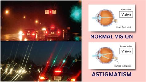 Astigmatism: Clear Vision & Effective Treatments