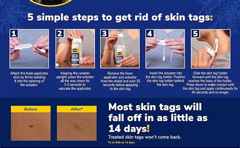 Unveiling the Ultimate Solution for A Flawless Skin: Effortless At-Home Skin Tag Removal with Domain_10!