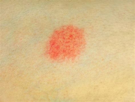 Atasi Dermatitis Numularis: Gejala & Cara Mengobati