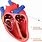 Atrial Cardiomyopathy