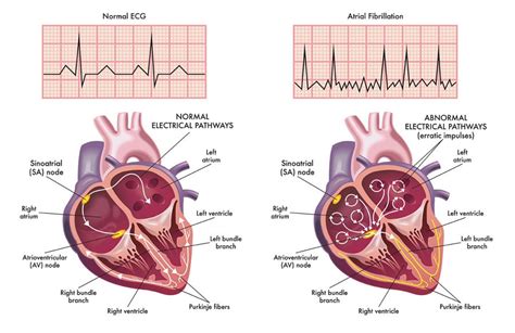 Atrial Fibrillation